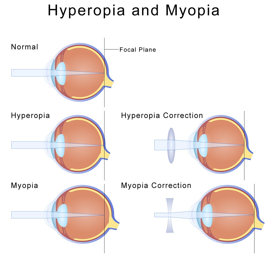 hypermetropia