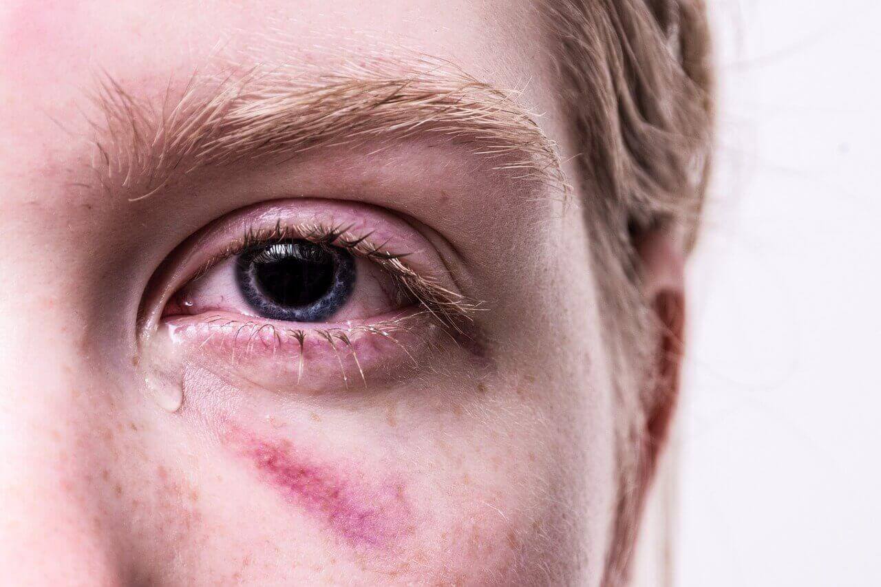 Eye trauma
